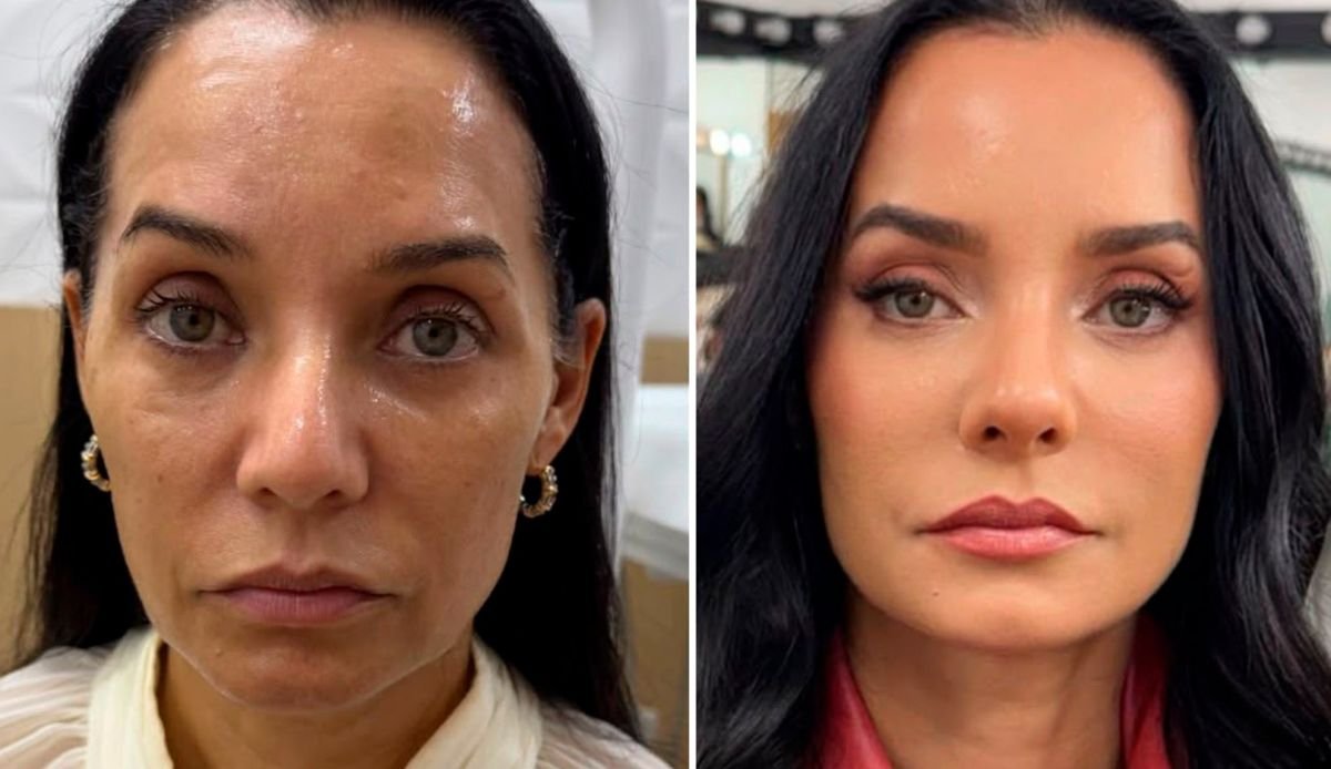 Mônica Carvalho mostrando o rosto após harmonização facial